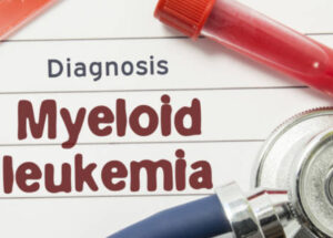 Acute Myeloid Leukemia Symptoms, Signs, Causes, And Treatments