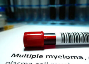 Multiple Myeloma Symptoms, Signs, Causes, And Treatments
